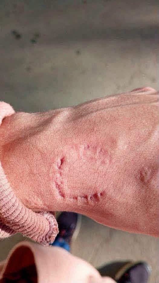Una marca en el brazo de un estudiante preocupó a su madre hasta que la escuela revisó lo ocurrido en clase